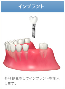 インプラント